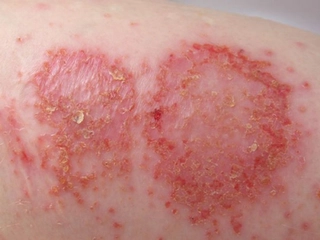 Vücutta Enfeksiyon Belirtileri ve Tedavisi