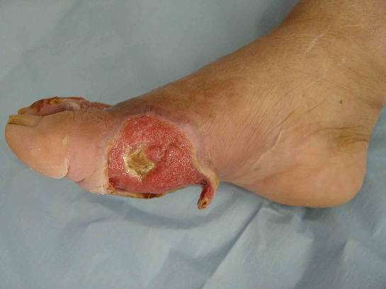 Ayakta Enfeksiyon Belirtileri ve Tedavisi