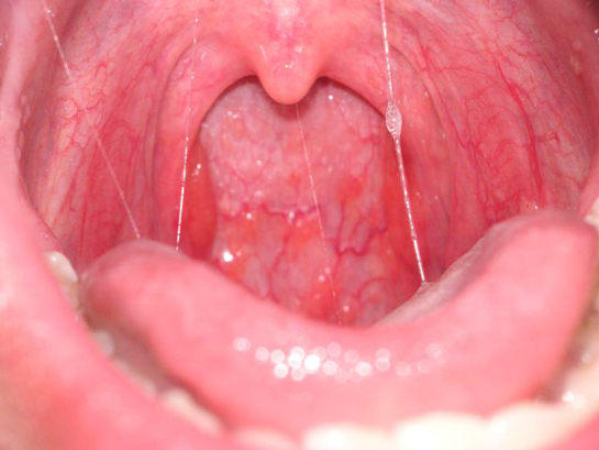 Çocuklarda Boğaz Enfeksiyonuna Ne İyi Gelir?